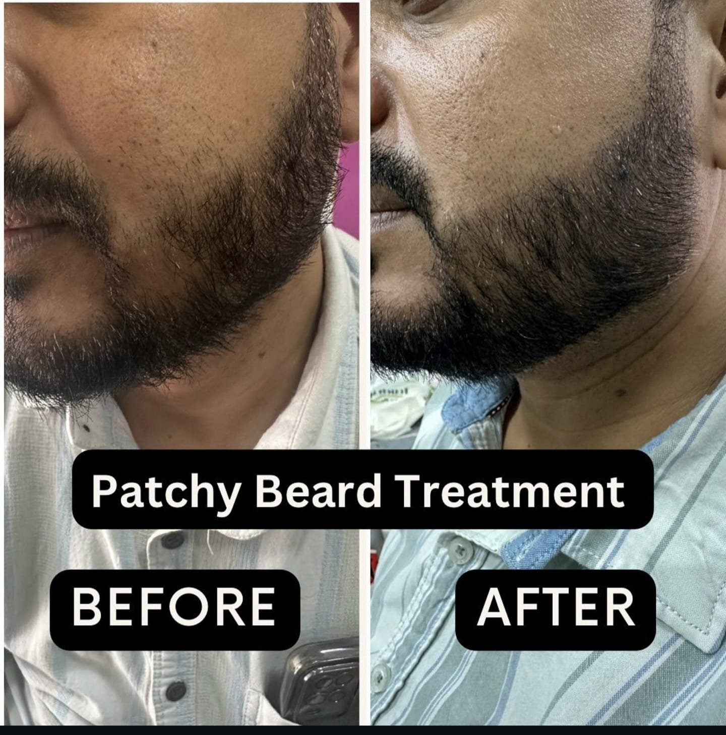 Beard & Facial Contour Hair Density Restoration Before Treatment
