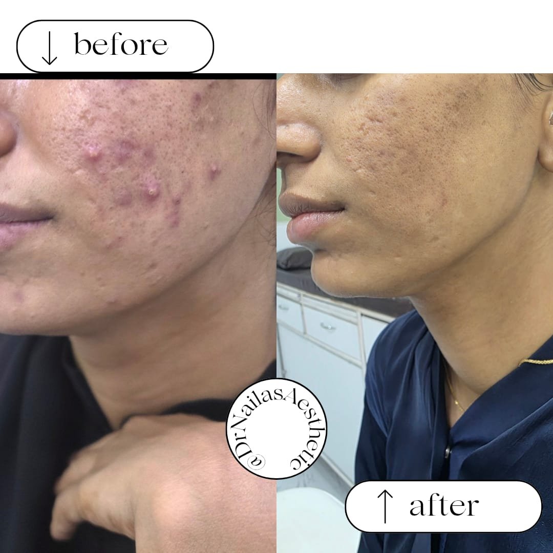 Acne Treatment - Authentic Clinical Result Photo