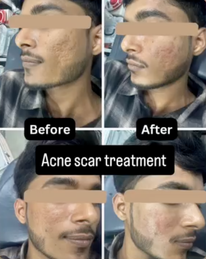 Acne Scar Treatment - Authentic Clinical Result Photo