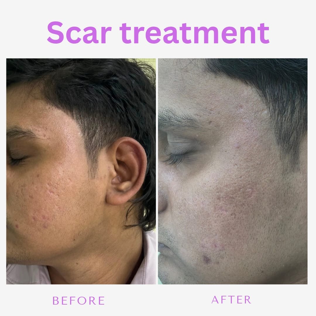Acne Scar Resurfacing & Smooth Texture - Authentic Clinical Result Photo