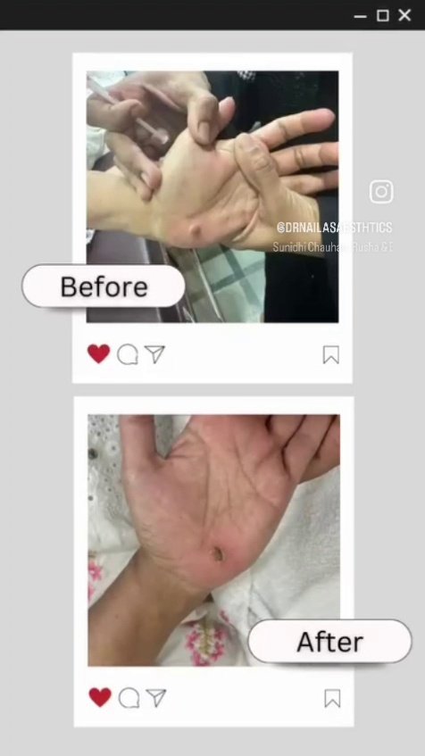 Laser Photo-Rejuvenation & Skin Toning