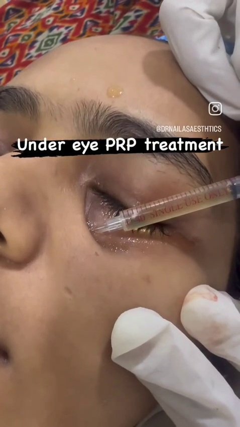 Q-Switched Laser Tattoo Removal