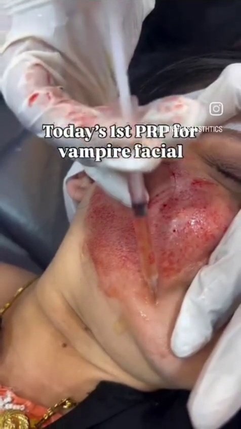 Vampire Facial