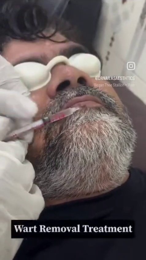 Mole & Wart Removal
