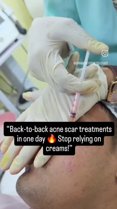 Acne Scar Laser Resurfacing Procedure